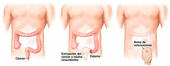Colostomía: tratamiento para cáncer de ano