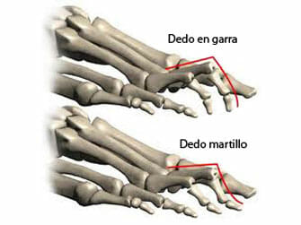 Dedos en garra y en martillo