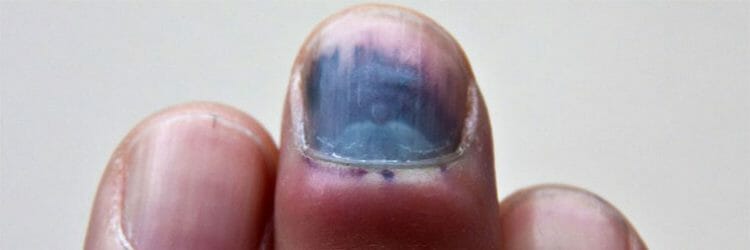 Diagnóstico del hematoma subungueal