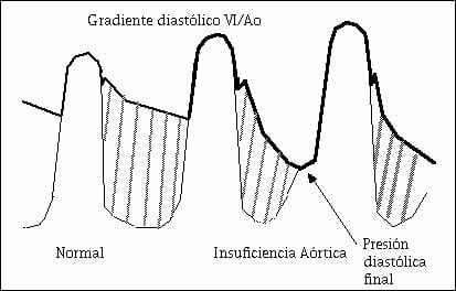 Diagnóstico de la insuficiencia aórtica