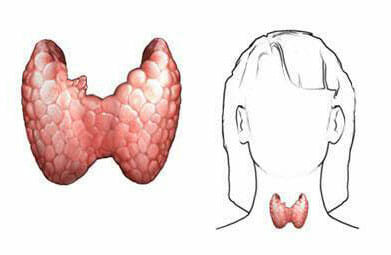Diagnóstico de la tiroiditis de Hashimoto