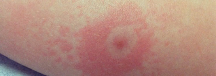 Enfermedad de Lyme