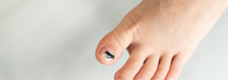 Hematoma subungueal