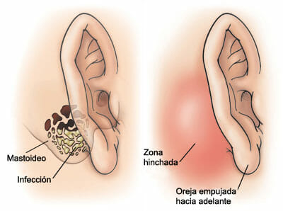 Síntomas de la mastoiditis