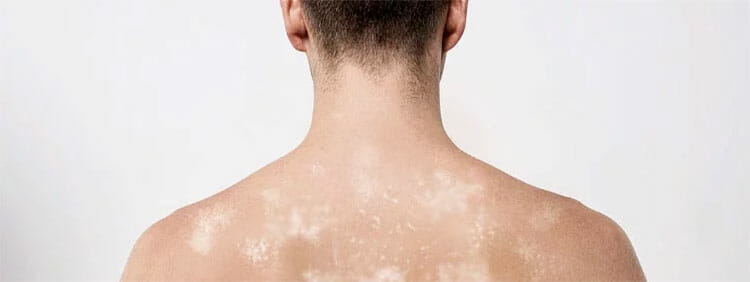 Pitiriasis versicolor: causas, síntomas y tratamiento