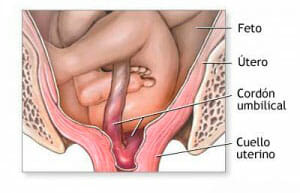 Causas del prolapso del cordón umbilical
