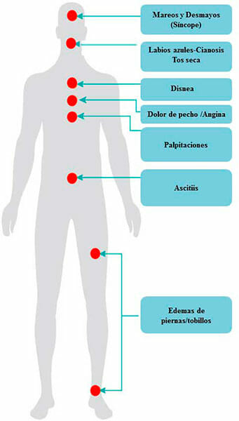 Síntomas de la hipertensión pulmonar