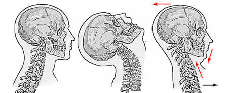 Causas del latigazo cervical