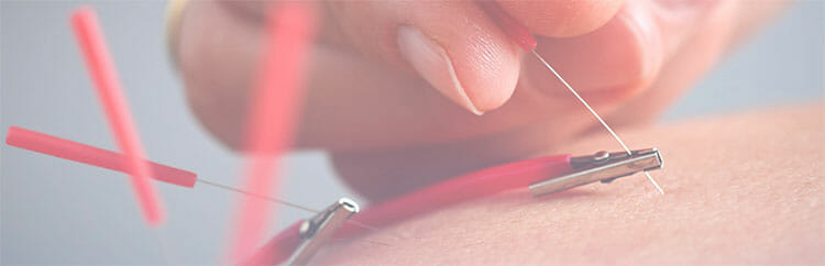 Electroacupuntura