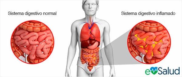 Causas de la peritonitis