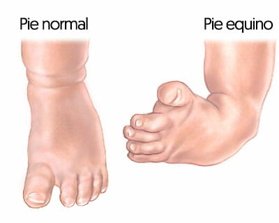 Síntomas del pie equino