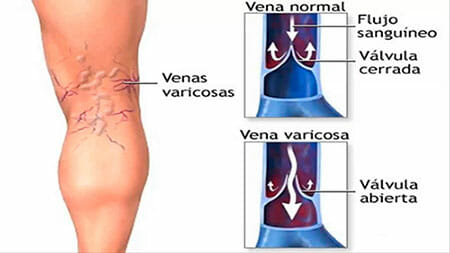 Causas de las varices