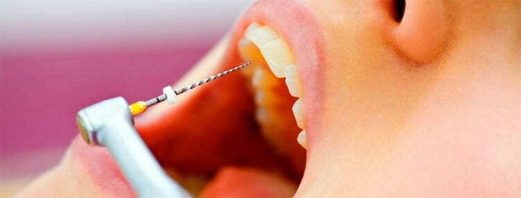 Endodoncia: qué es, cuándo se realiza y cuánto tiempo dura