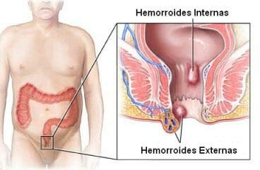 Tipos de hemorroides