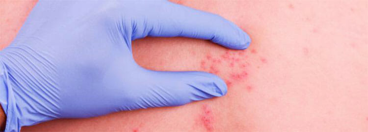 Herpes zóster