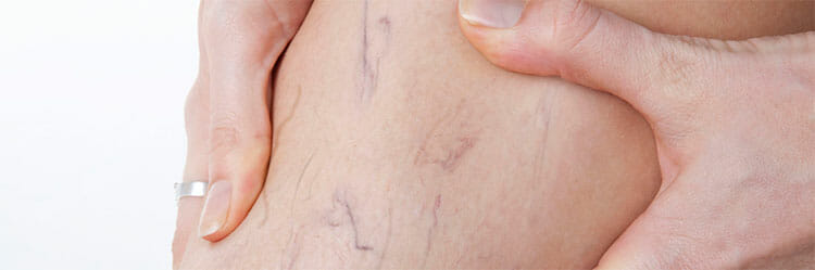 Varices