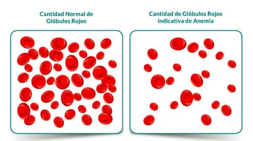 Anemia: hemoglobina baja