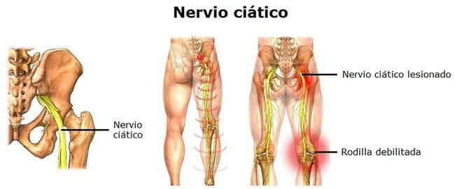 Causas de la ciática