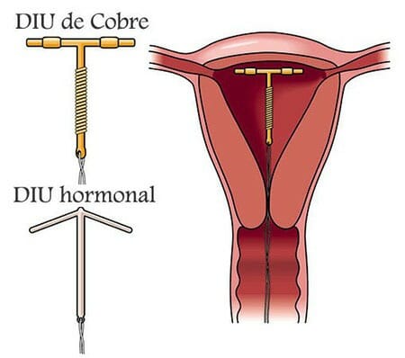Funcionamiento del DIU