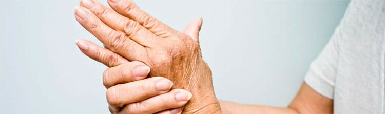 Artritis reumatoide: qué es, síntomas, diagnóstico y tratamiento