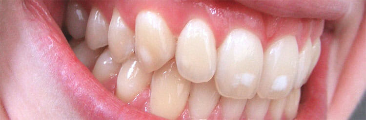 Fluorosis: causas, síntomas, tratamiento y prevención