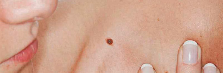 Lunar peligroso o melanoma