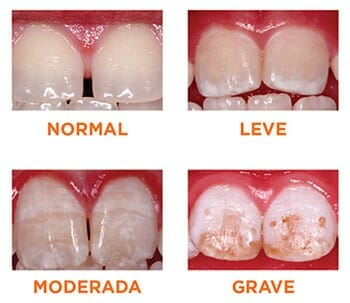 Tipos de fluorosis
