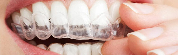 Blanqueamiento dental por férulas