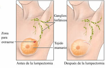 Antes y después de una lumpectomía