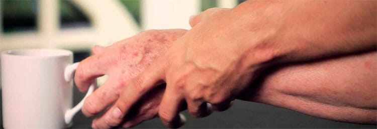 Parkinson