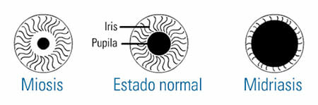 Pupilas dilatadas o midriasis
