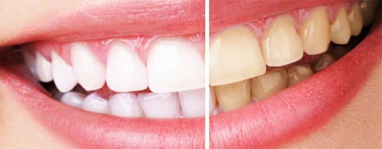 Tipos de blanqueamiento dental