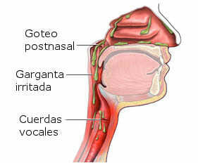 Goteo postnasal y mucosidad en la garganta