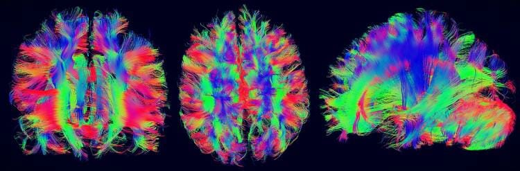 Parálisis cerebral