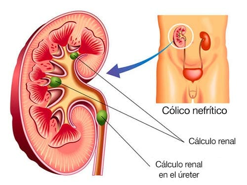 Causas del cólico nefrítico