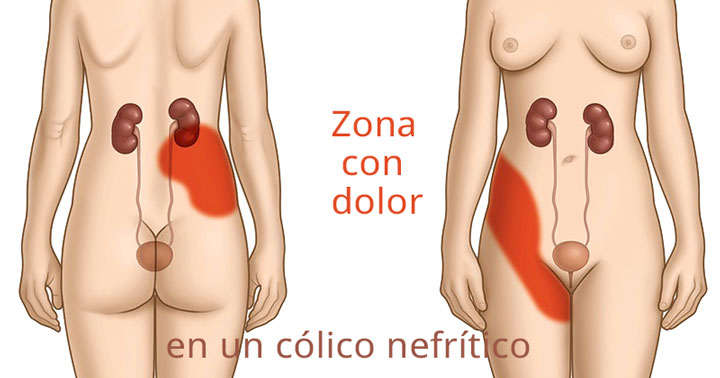 Síntomas del cólico nefrítico