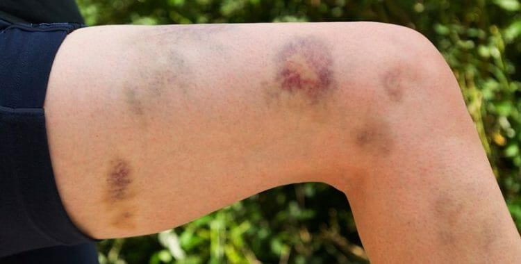 Consecuencias de las plaquetas bajas