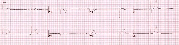 Electrocardiograma para detectar bradicardia sinusal