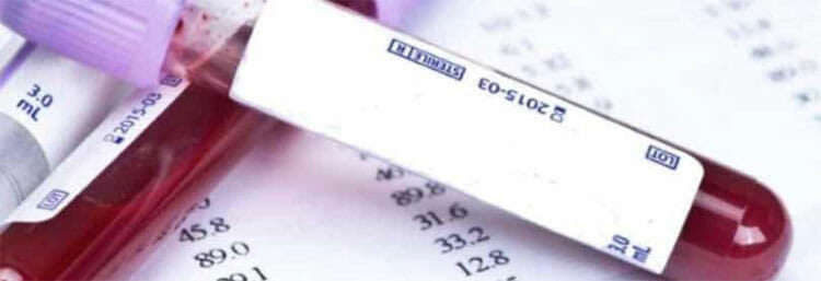 Ferritina baja: causas, síntomas, tratamiento y consejos