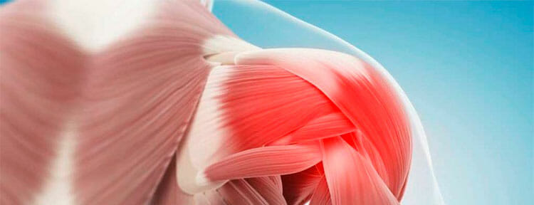 Separación acromioclavicular