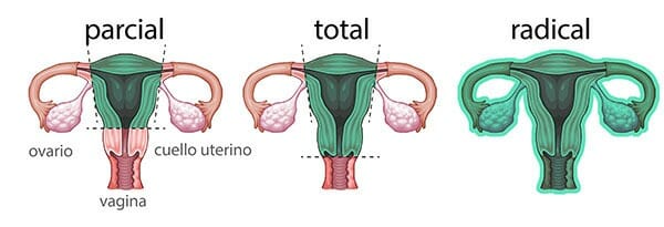 Tipos de histerectomía