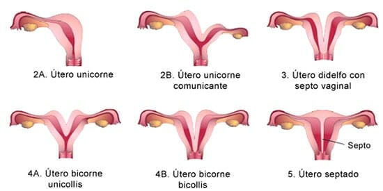 Útero bicorne y embarazo