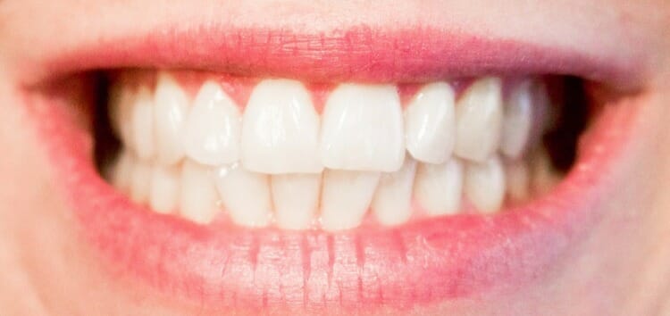 Caries