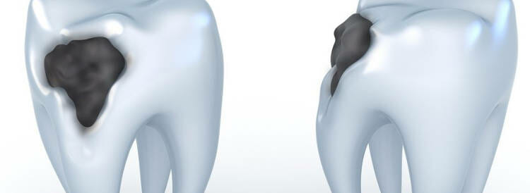 Qué son las caries