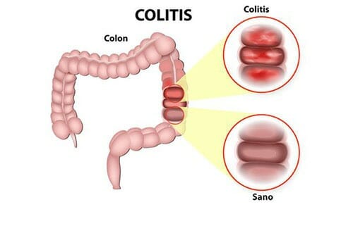 Colitis ulcerosa