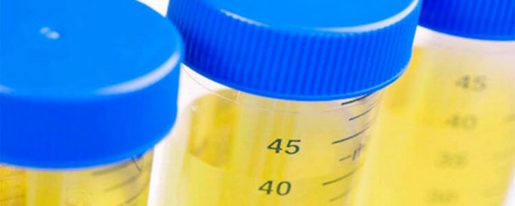 Hematuria