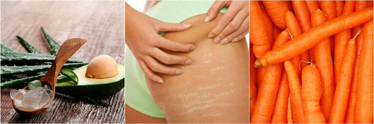 Remedios naturales para prevenir las estrías