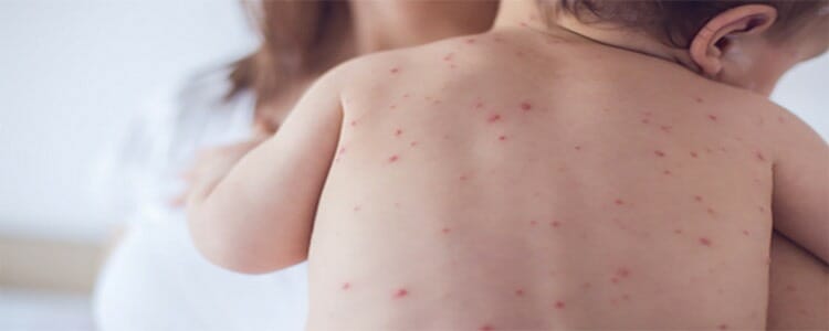 Varicela en niños