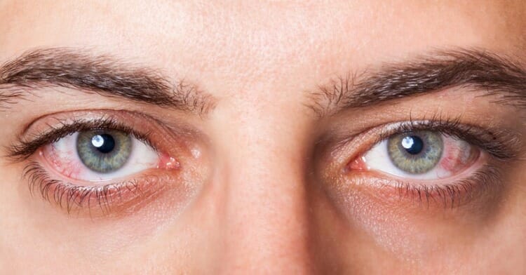 Conjuntivitis sintomas