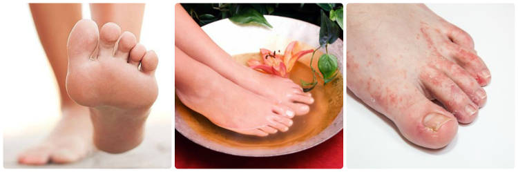 Hongos en los pies: causas, síntomas y tratamiento